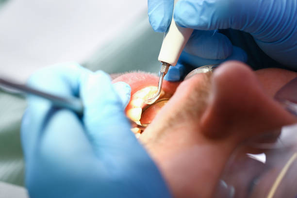 Best Dental Abscess Treatment in Tehaleh, WA
